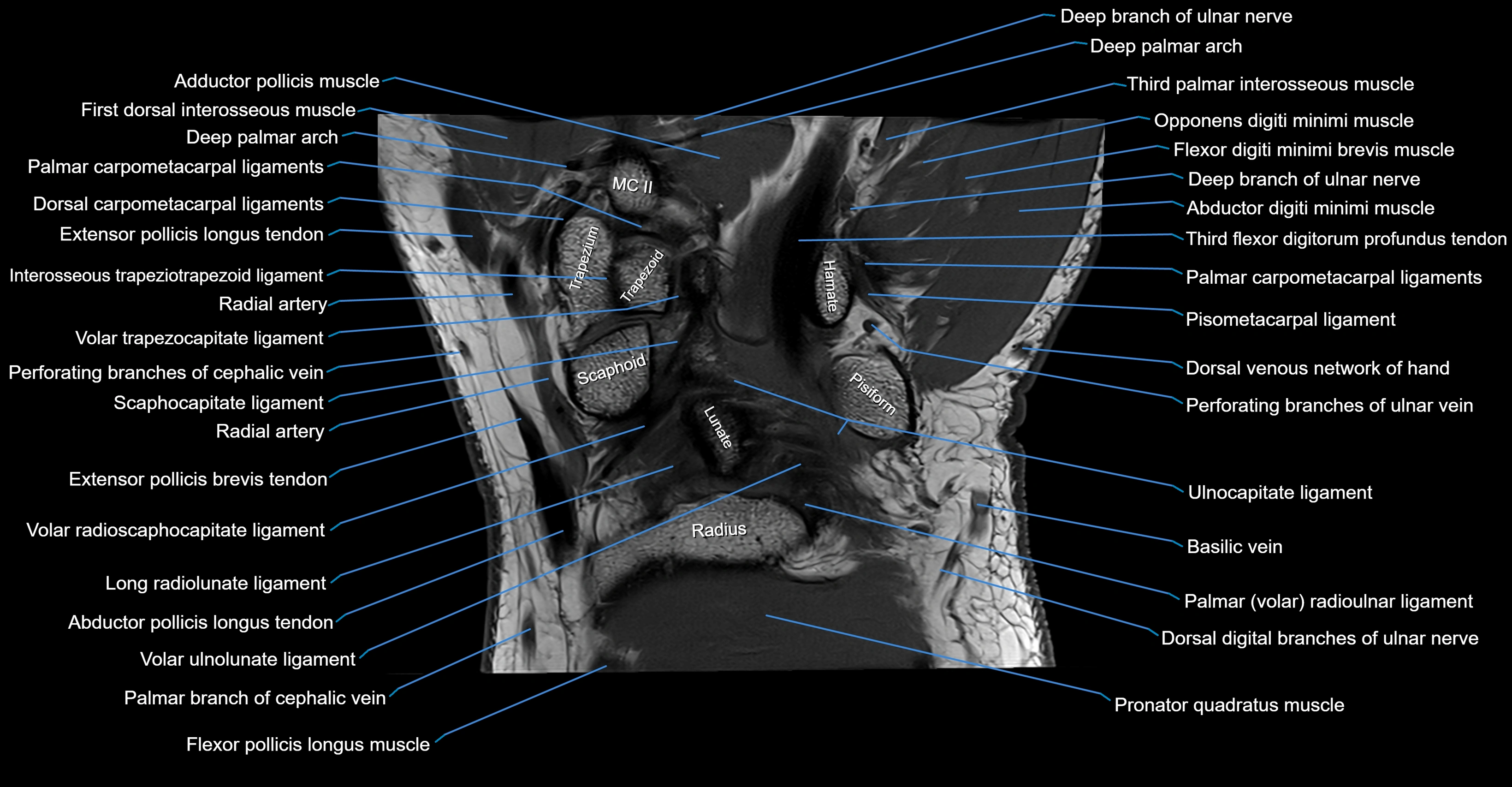 MRI wrist coronal cross sectional anatomy 3T  radiology  image-img-00001-00016.webp